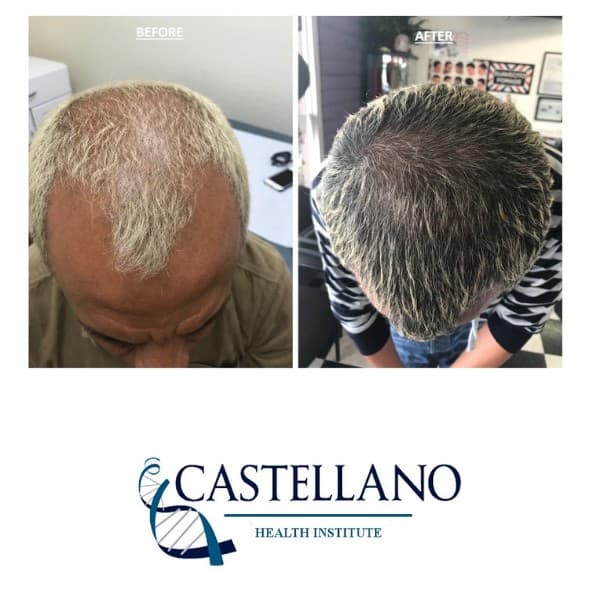 PRP hair-loss before and after — top-down view of a male patient's scalp, labeled before and after.