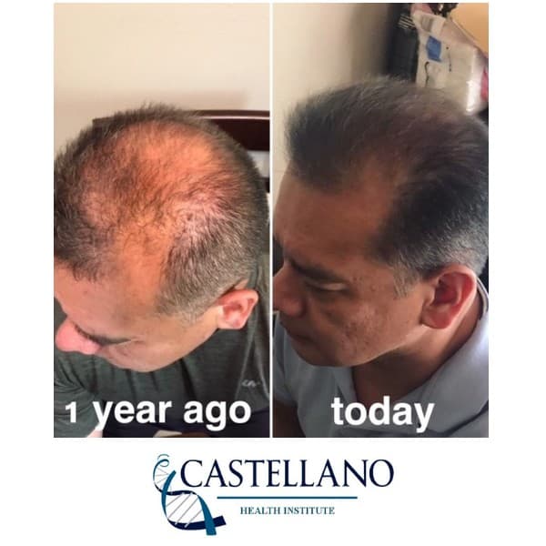 PRP hair-loss before and after — side profile showing hairline change, labeled one year ago and today.
