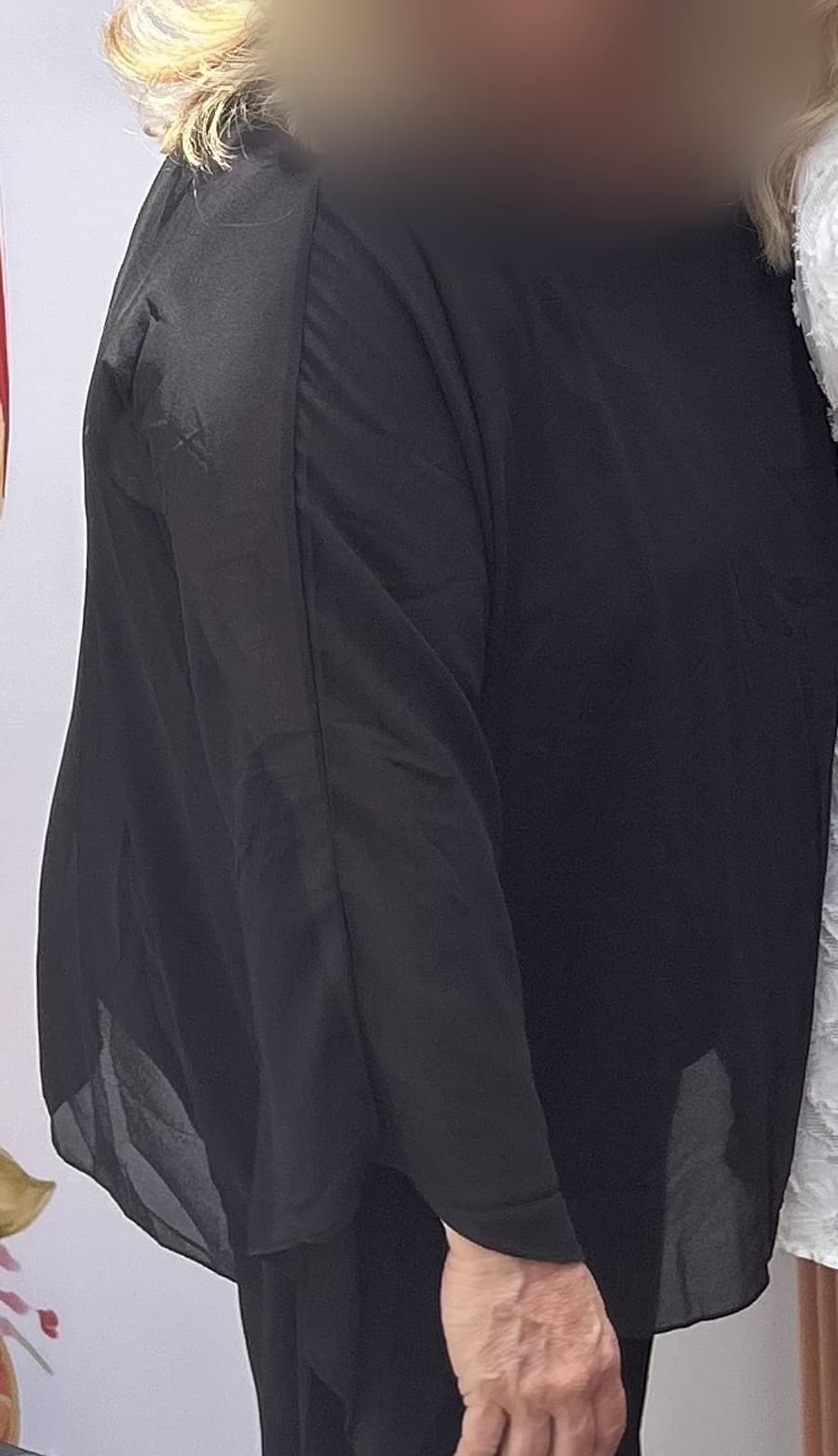 Long Beach weight-loss patient before her care with Dr. Castellano — face blurred at the patient's request